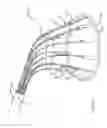 Fig. 24 - Preventing tissue ingrowth into constricting cords after implantation