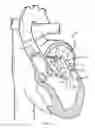 Fig. 22 - Delivering a constricting cord to a cardiac valve annulus using balloon-assisted positioning