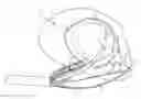 Fig. 01 - Preventing dislodgement of a constricting cord that has been affixed to a cardiac valve annulus