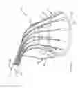 Fig. 09 - Preventing dislodgement of a constricting cord that has been affixed to a cardiac valve annulus