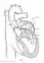 Fig. 22 - Preventing dislodgement of a constricting cord that has been affixed to a cardiac valve annulus