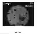Fig. 04 - Bone graft with a tannin-hydroxyapatite scaffold and stem cells for bone engineering