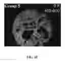 Fig. 07 - Bone graft with a tannin-hydroxyapatite scaffold and stem cells for bone engineering