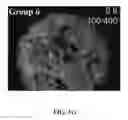 Fig. 08 - Bone graft with a tannin-hydroxyapatite scaffold and stem cells for bone engineering