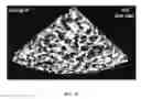 Fig. 22 - Bone graft with a tannin-hydroxyapatite scaffold and stem cells for bone engineering