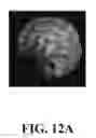 Fig. 49 - Bone graft with a tannin-hydroxyapatite scaffold and stem cells for bone engineering