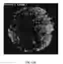 Fig. 52 - Bone graft with a tannin-hydroxyapatite scaffold and stem cells for bone engineering