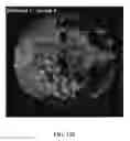 Fig. 53 - Bone graft with a tannin-hydroxyapatite scaffold and stem cells for bone engineering