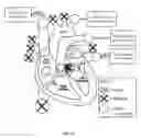 Fig. 02 - Cardiac assist device