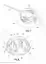 Fig. 08 - Insulin pump dermal infusion set having partially integrated mechanized cannula insertion with disposable activation portion