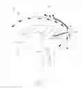 Fig. 02 - Shunt systems and methods for removing excess cerebrospinal fluid