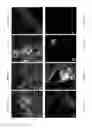 Fig. 08 - LABEL-FREE SINGLE AND MULTI-PHOTON FLUORESCENCE SPECTROSCOPY TO DETECT BRAIN DISORDERS AND DISEASE: ALZHEIMER, PARKINSON AND AUTISM FROM BRAIN TISSUE, CELLS, SPINAL FLUID AND BODY FLUIDS