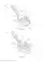 Fig. 02 - Vacuum-Assisted Vaginal Positioning Device