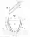 Fig. 04 - Prosthetic heart valve with reduced stitching