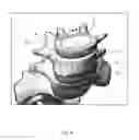 Fig. 06 - Expandable intervertebral fusion implant