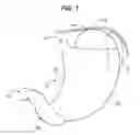Fig. 02 - Safe sleeve gastrectomy