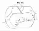 Fig. 09 - Safe sleeve gastrectomy