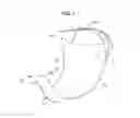 Fig. 02 - Safe sleeve gastrectomy and intestinal switch