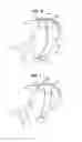 Fig. 03 - Safe sleeve gastrectomy and intestinal switch