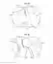 Fig. 08 - Safe sleeve gastrectomy and intestinal switch
