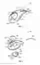 Fig. 02 - Intraocular drainage device