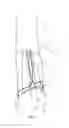 Fig. 06 - JEJUNOSTOMY TUBE AND METHOD