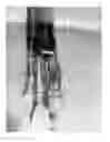 Fig. 07 - JEJUNOSTOMY TUBE AND METHOD