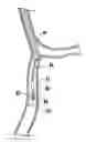 Fig. 01 - Occlusion traversal robotic catheter system