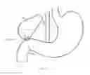 Fig. 05 - Anastomotic drainage stent
