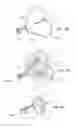 Fig. 31 - Low-profile single and dual vascular access device