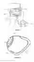Fig. 09 - Patient-specific surgical guide