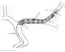 Fig. 01 - ASPIRATION AND MECHANICAL THROMBECTOMY METHODS