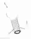 Fig. 102 - ASPIRATION AND MECHANICAL THROMBECTOMY METHODS