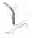 Fig. 192 - ASPIRATION AND MECHANICAL THROMBECTOMY METHODS