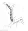 Fig. 196 - ASPIRATION AND MECHANICAL THROMBECTOMY METHODS
