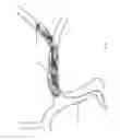 Fig. 197 - ASPIRATION AND MECHANICAL THROMBECTOMY METHODS