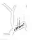 Fig. 199 - ASPIRATION AND MECHANICAL THROMBECTOMY METHODS