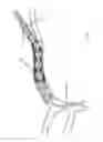 Fig. 201 - ASPIRATION AND MECHANICAL THROMBECTOMY METHODS