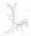 Fig. 205 - ASPIRATION AND MECHANICAL THROMBECTOMY METHODS