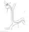 Fig. 207 - ASPIRATION AND MECHANICAL THROMBECTOMY METHODS