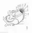 Fig. 221 - ASPIRATION AND MECHANICAL THROMBECTOMY METHODS