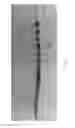 Fig. 89 - ASPIRATION AND MECHANICAL THROMBECTOMY METHODS