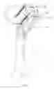 Fig. 06 - INTERTROCHANTERIC FIXATION DEVICE