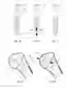 Fig. 02 - Anti-penetration bone implant device and method