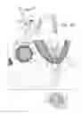 Fig. 09 - BONE GRAFT INJECTION OSTEOTOME