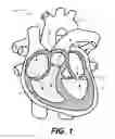 Fig. 02 - Transapical mitral valve replacement