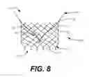 Fig. 09 - Transapical mitral valve replacement