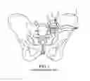 Fig. 02 - Methods of fusing a sacroiliac joint via a cranial access