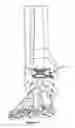 Fig. 15 - TOTAL ANKLE REPLACEMENT JOINT