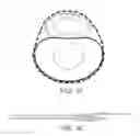 Fig. 31 - Stent alignment during treatment of a bifurcation